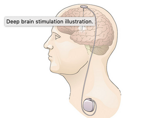 Deep Brain Stimulation illustration